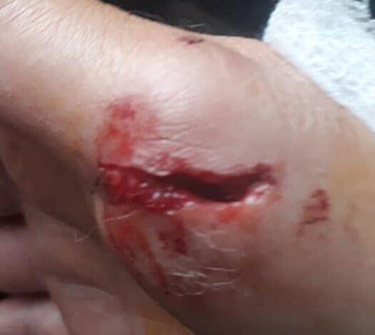 mano mordida x perro ana E - Diario Resumen de la región