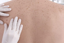 diagnostico melanoma e1775761374759 - Diario Resumen de la región