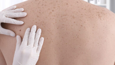 diagnostico melanoma e1775761374759 - Diario Resumen de la región