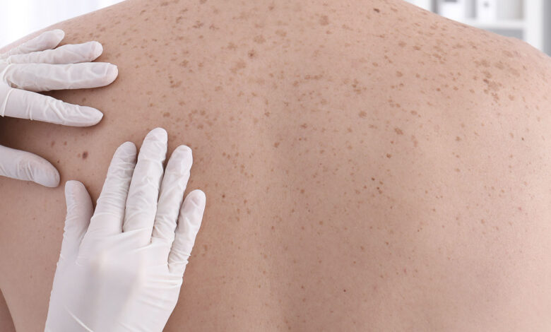 diagnostico melanoma e1775761374759 - Diario Resumen de la región