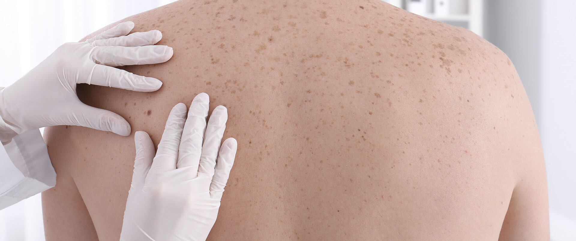 diagnostico melanoma e1775761374759 - Diario Resumen de la región